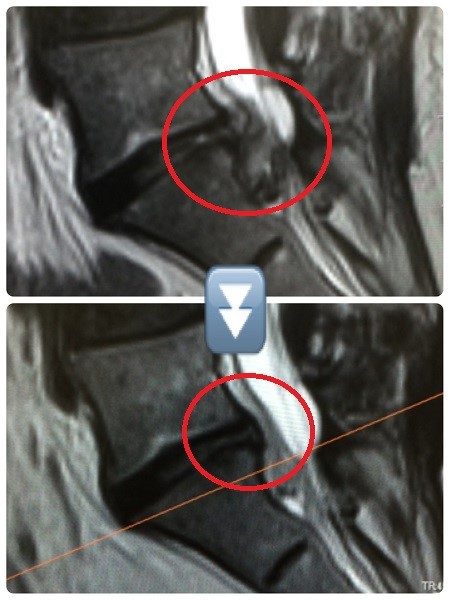 腰椎椎間板ヘルニア改善例（MRI画像）